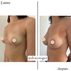 aumento de mamas - Dra. Tatiana Siniger