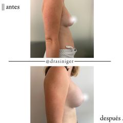 aumento de mamas - Dra. Tatiana Siniger
