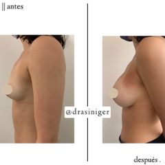 aumento de mamas - Dra. Tatiana Siniger