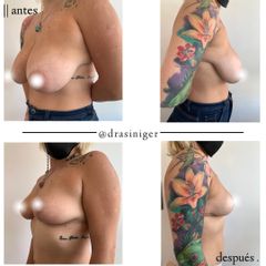 Mastopexia - Dra. Tatiana Siniger