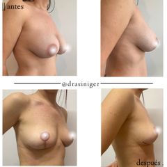 mastopexia - Dra. Tatiana Siniger