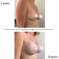 aumento de mamas - Dra. Tatiana Siniger