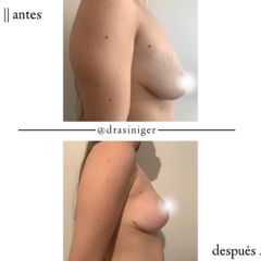 mastopexia - Dra. Tatiana Siniger