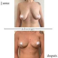 mastopexia - Dra. Tatiana Siniger