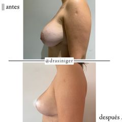 Mastopexia - Dra. Tatiana Siniger