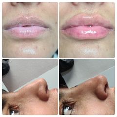 Rinomodelacion más aumento de labio - Dr. Néstor Arredes
