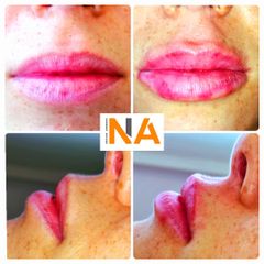 Aumento de labios - Dr. Néstor Arredes