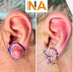 Reseccion de tumor más otoplastia - Dr. Néstor Arredes