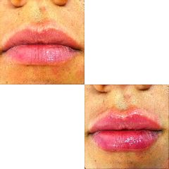 Relleno de labios - Dr. Néstor Arredes
