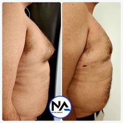 Ginecomastia - Dr. Néstor Arredes