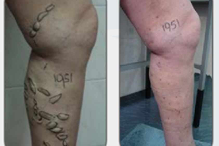 Flebología antes y después - 267012