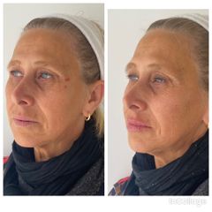 Rejuvenecimiento Facial - Full Face - Dra. Luciana Acosta