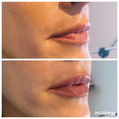 Relleno de labios con ácido hialurónico - Dra. Luciana Acosta