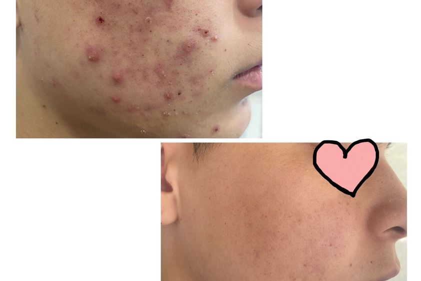 Tratamiento acné antes y después - 856434