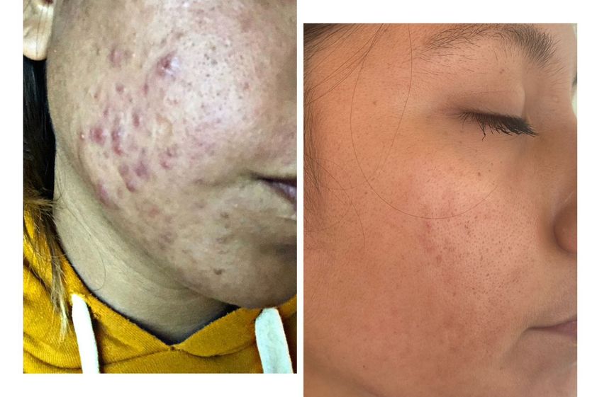 Tratamiento acné antes y después - 856444
