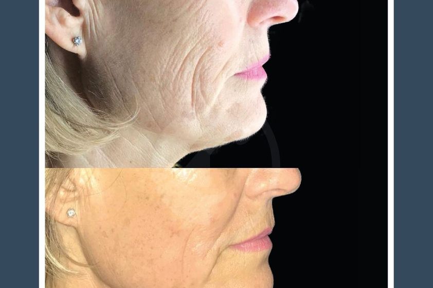 Rellenos faciales antes y después - 853849