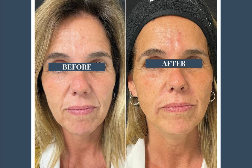 Rellenos faciales antes y después - 853861