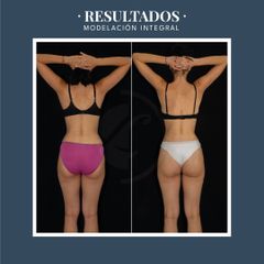 Liposucción - Dr. Federico Coccaro