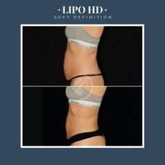 Liposucción - Dr. Federico Coccaro