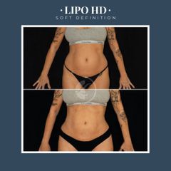 Liposucción - Dr. Federico Coccaro