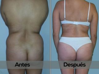 Antes y despues de Lipoescultura y Abdominoplastia