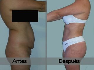 Antes y despues de Lipoescultura y Abdominoplastia