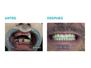 Implantes dentales - Dr. Andrés Etbul