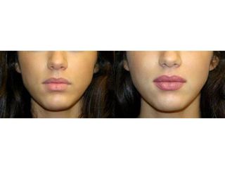 Aumento de labios - Dr. Andrés Etbul