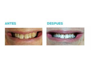 Blanqueamiento dental - Dr. Andrés Etbul