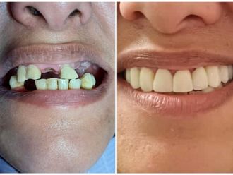 Implantes dentales - 853987