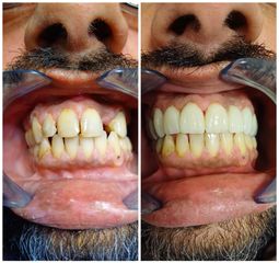Carillas dentales - Dr. Andrés Etbul