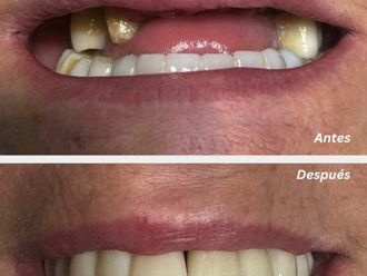 Implantes dentales antes y después - 881146
