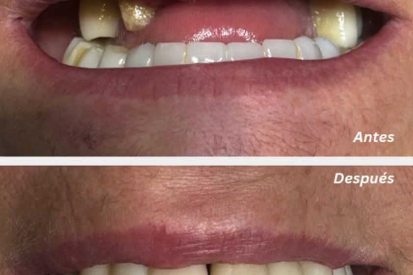 Implantes dentales antes y después - 881146