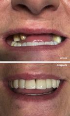 Implantes Dentales - Dr. Andrés Etbul
