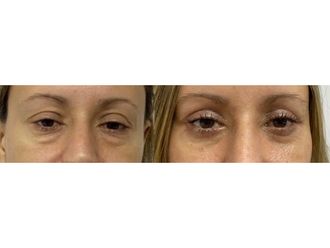 Blefaroplastia - 842415