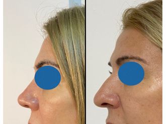 Rinoplastia - 842420
