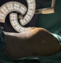 Aumento Glúteos - Dr. Ezequiel Barbosa