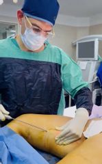 Liposucción - Dr. Ezequiel Barbosa