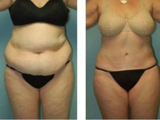 Abdominoplastia