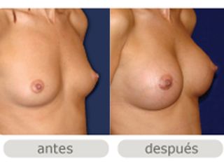 Cirugía de mamas