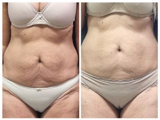 Abdominoplastia - Sergio Eduardo Jose