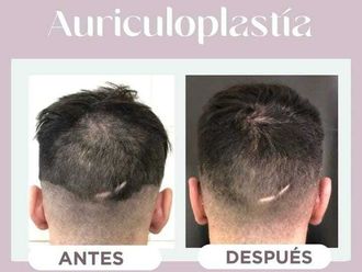 Otoplastia antes y después - 869167