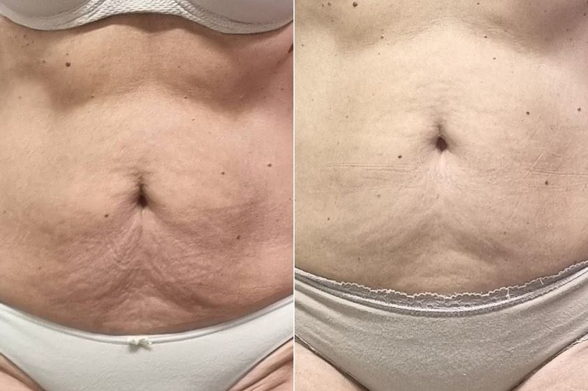Radiofrecuencia antes y después - 869563