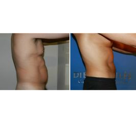 abdominoplastia 1 - dr. diego aviles