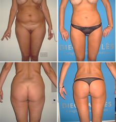 Lipoescultura