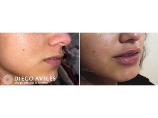 Relleno de labios - Dr. Diego Avilés