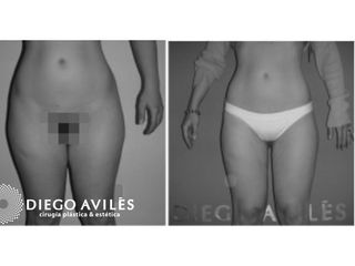 Liposucción - Dr. Diego Avilés