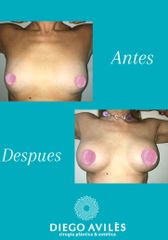 Aumento de mamas - Dr. Diego Avilés