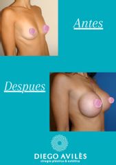 Aumento mamas  - Dr. Diego Avilés