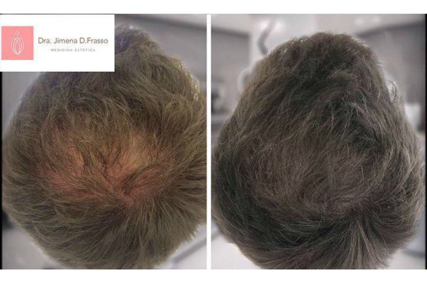Plasma Rico en Plaquetas antes y después - 632505